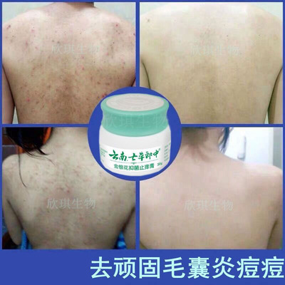 云南七草朗中毛囊炎头部专用长疙瘩长头皮痘痘脸上药膏溢脂性头癣