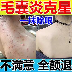 后背胸口手臂上毛囊炎专用祛痘痘屁股上的小疙瘩膏药贴长真菌感染