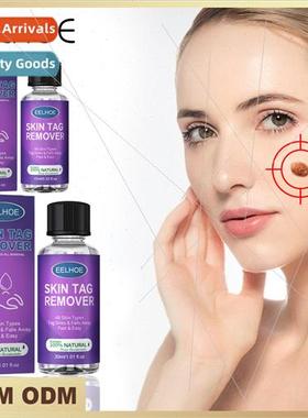 Warts quid Pointing moles to remove chicken eye flat monkey