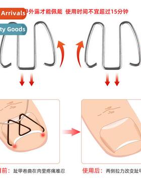 Ortho Wire Ingrown Nail Orthotics Ingrown Nail Ortho Wire To