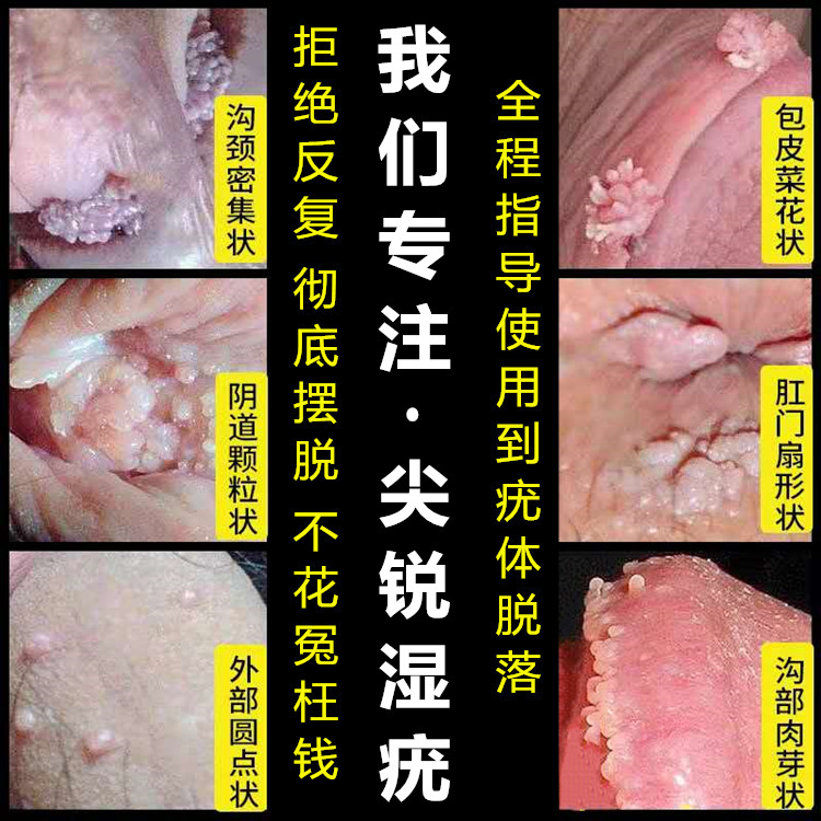 去除尖锐疣湿疣面部扁平疣丝状男女性私处肛门周克疣液净假性湿疣