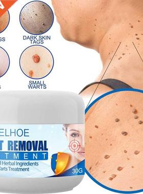 Painless Wart Remover Cream Treatment of The Skin of The Nec