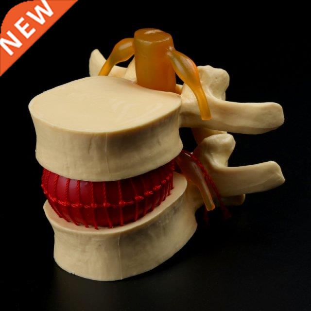Anatomical Spine Lumbar Disc Herniation Anatomy Medical Teac