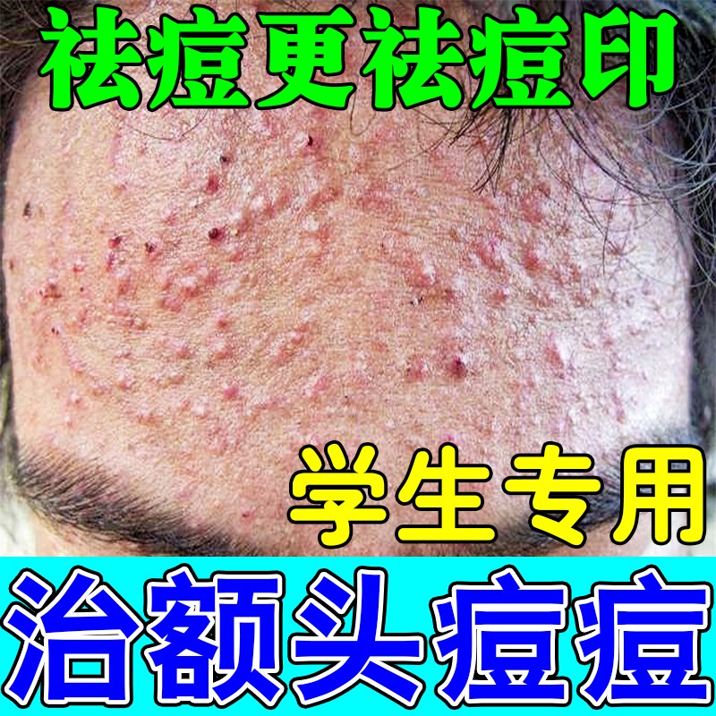 去额头痘痘青春痘祛豆痘膏男女学生额头红肿疙瘩去除痘印痘坑药膏