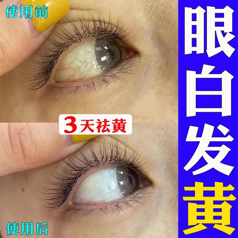 眼白发黄眼睛清澈去黄红血丝滴眼液去除眼底黄斑病变叶黄素眼水