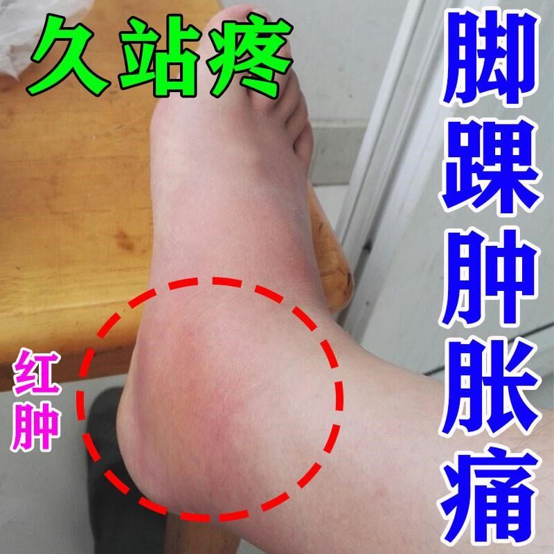脚踝扭伤崴脚陈年旧伤脚腕肿痛脚腕关节痛腕骨关节焱脚踝腱鞘疼痛