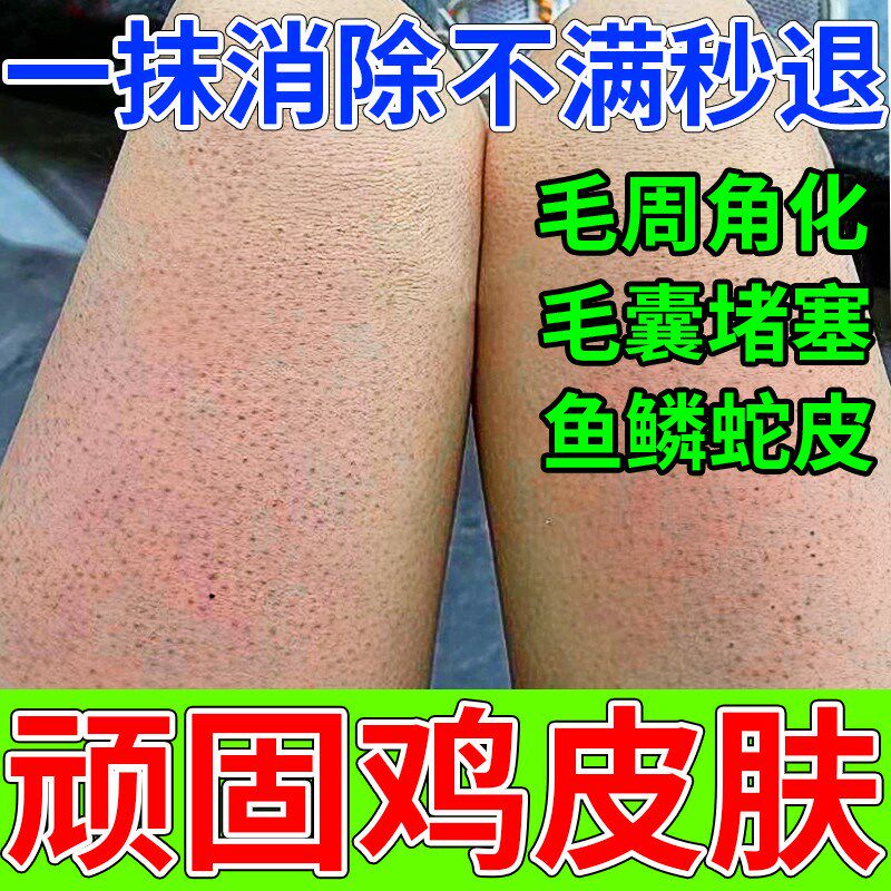 鸡皮肤疙瘩毛囊角化药膏毛周角化症专用去除全身手臂腿孔堵塞疏通