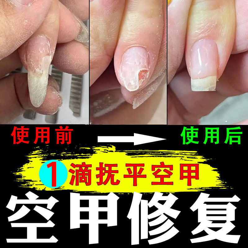 指甲甲肉分离修复空甲甲床竖纹肉包甲矫正手脚指甲变空增长修复液