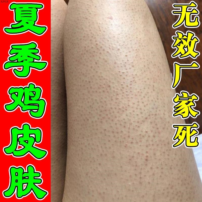 去除鸡皮肤疙瘩毛囊角化药膏胳膊毛周角化皮肤粗糙神器