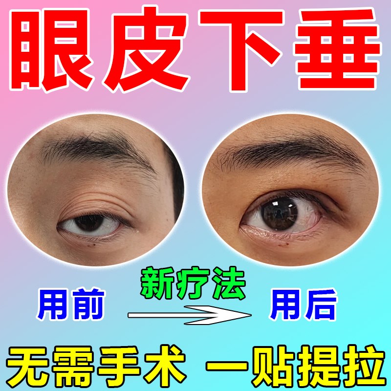 眼皮下垂提拉眼膜双眼皮神器上眼睑防松弛紧致大小眼矫正器专用贴