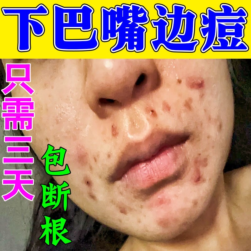 下巴反复长痘痘淋巴痘腮边痘嘴巴周围长痘熬夜上火内调理去痘药膏