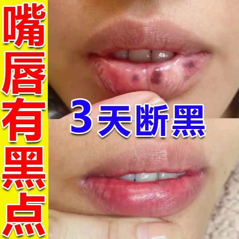 嘴唇黑点去除改善嘴唇黑斑黑色素沉淀淡化唇周暗沉唇纹专用润唇膏