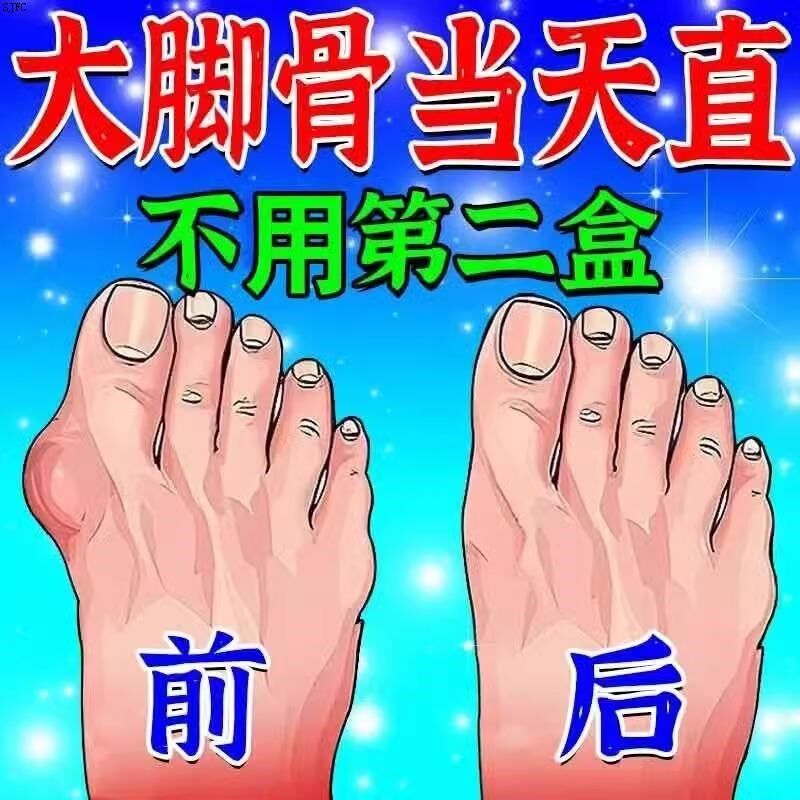 [不直全赔]大脚骨脚趾重叠专用膏贴拇外翻神器拇指外翻矫正专用SX