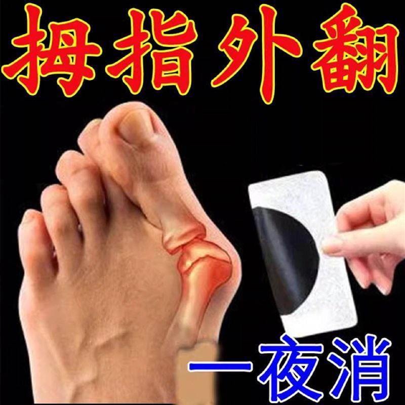 【80岁一贴直】拇指外翻贴大脚骨专用膏贴脚趾变形重叠矫正神器膏