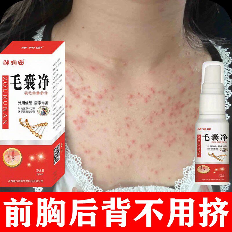 【背痘买他】身体祛痘喷雾快速改善淡化痘印粉刺背部抗痘男女通用