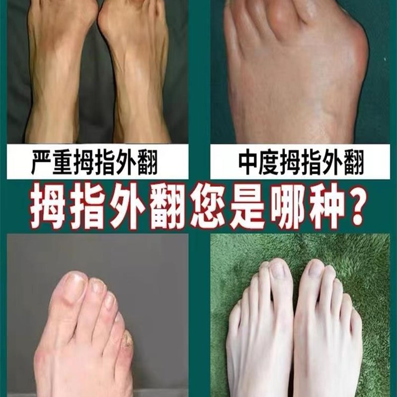 拇指外翻矫正贴足外翻纠正神器大脚骨防磨贴拇外翻治疗脚趾专用膏