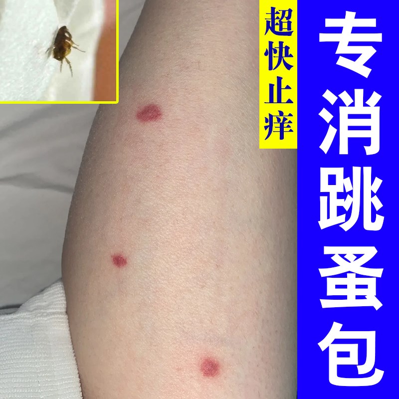 跳早咬小孩蚊虫螨虫叮咬小疙瘩痘痘小水泡发红去臭虫咬包温和乳膏