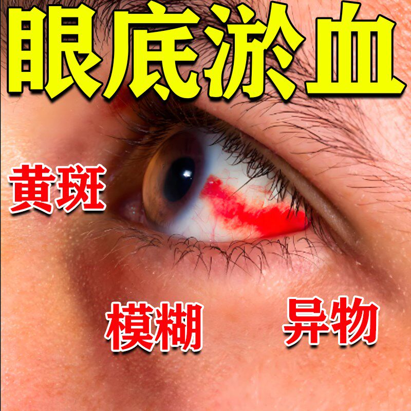黄斑病眼水去变眼底发黄眼底黄斑水肿眼睛发黄混浊模糊眼白出血