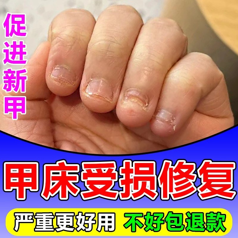 手脚甲床修复生长液啃咬指甲受损再生甲肉分离空甲护甲油甲床增长