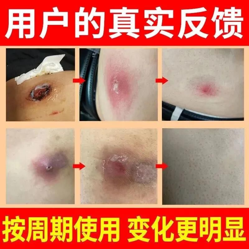 火疖子拔毒膏贴 疙瘩脓包红肿痘痘坐板疮拔脓膏硬块毛囊吸脓神器