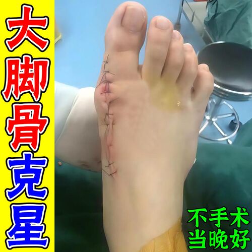 【50年大脚骨一夜直】拇指外翻膏贴拇外翻肌贴大脚骨脚趾矫正器