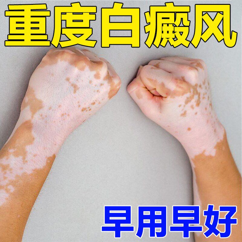 【白癜风克星】新本草白癜风祛消白斑药外用治疗修复促黑素修复膏