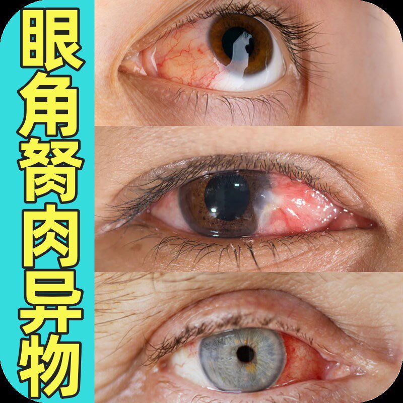 眼睛胬肉眼角滴眼液翼状息肉鱼眼眼球异物感发红发痒模糊酸胀干涩