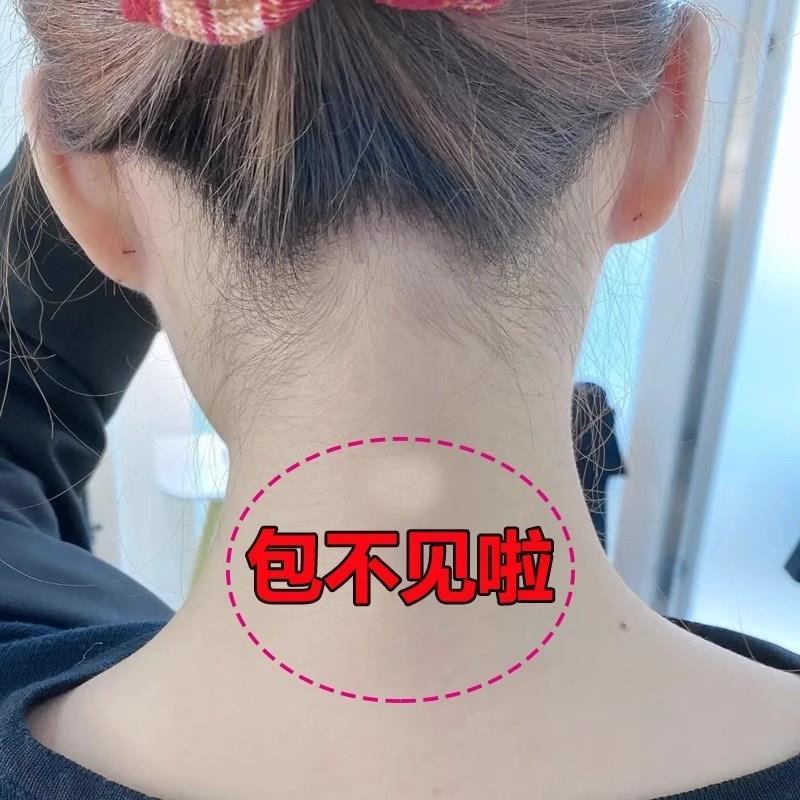 【包痊愈】富贵包消除神器修复颈部大椎鼓包肩颈脖子酸痛堵塞祛包