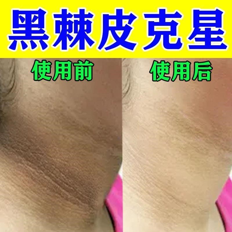 脖子黑棘皮病去除黑脖子洗不干净黑色素黑色素沉淀药膏颈部去死皮