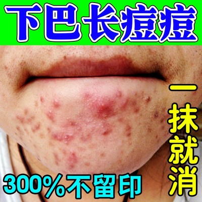下巴反复长痘痤疮膏祛痘重度暗疮去痘印淋巴痘腮边痘熬夜上火专用