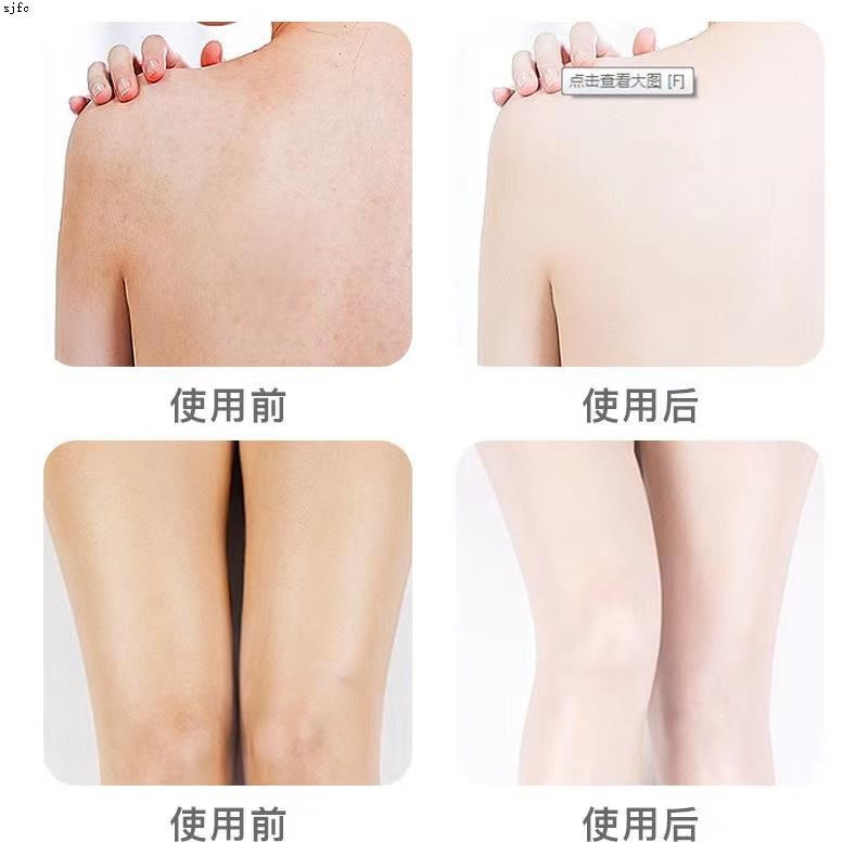 【去鸡皮神器】女士永久去鸡皮疙瘩毛囊角化去鸡皮肤鱼麟皮全身皂