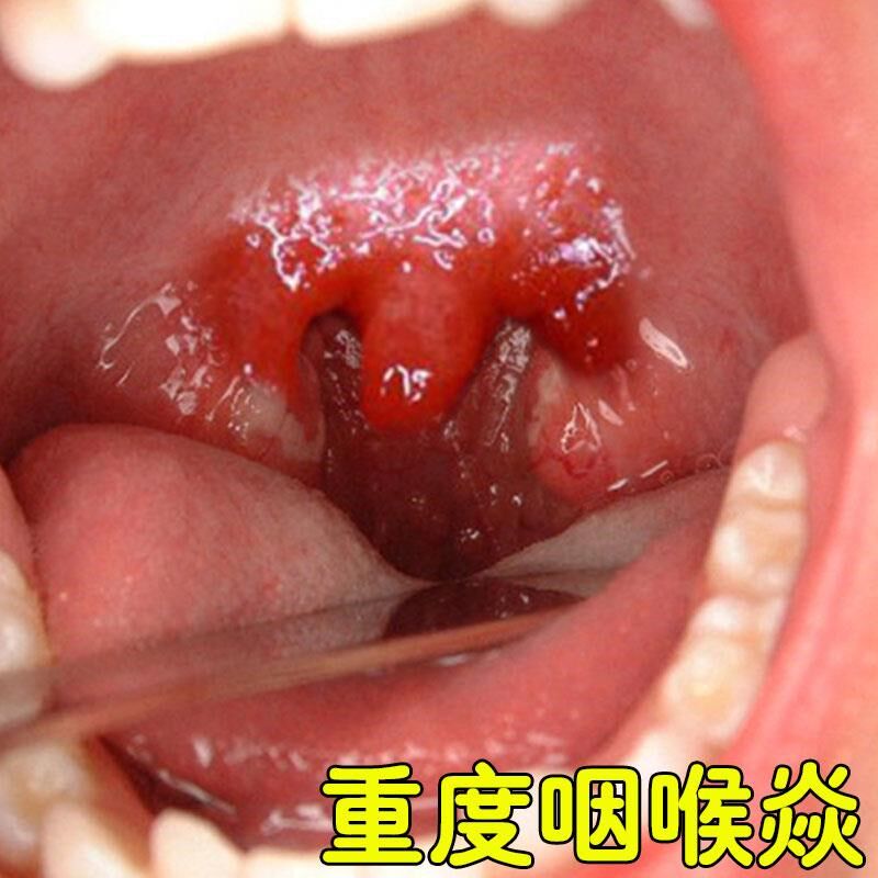 咳嗽喉咙疼有痰怎么办喉咙发焱肿痛淋巴滤泡多喉咙不适发痒咳嗽用