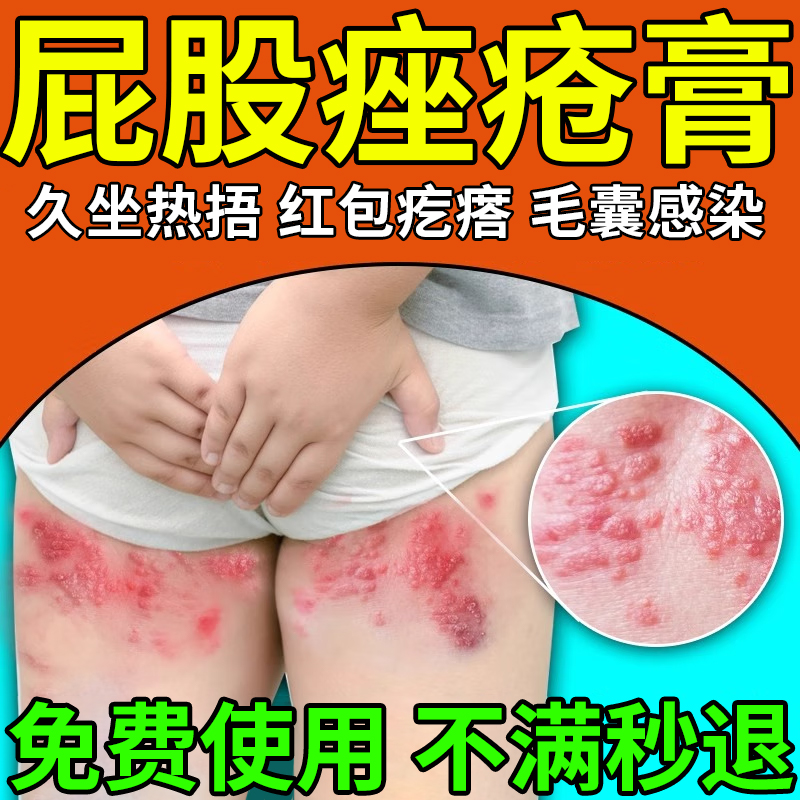 屁股痤疮膏上长痘痒起热疙