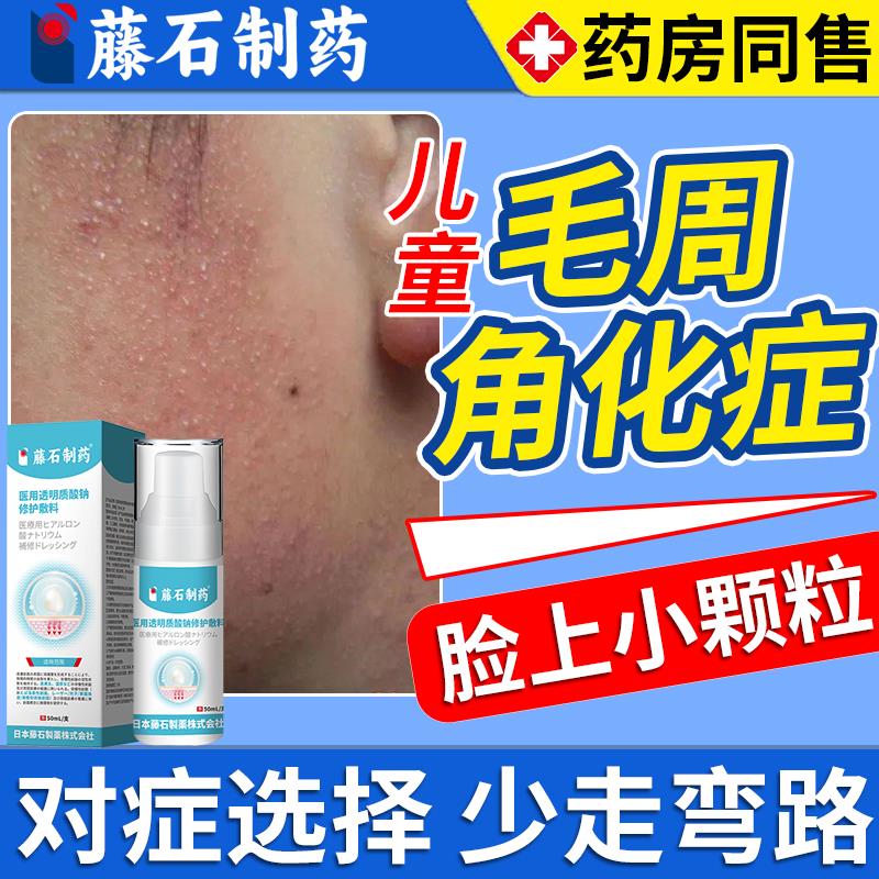 儿童面部毛周角化症鸡皮肤脸颊两边小颗粒起小疙瘩祛毛囊炎角化WQ