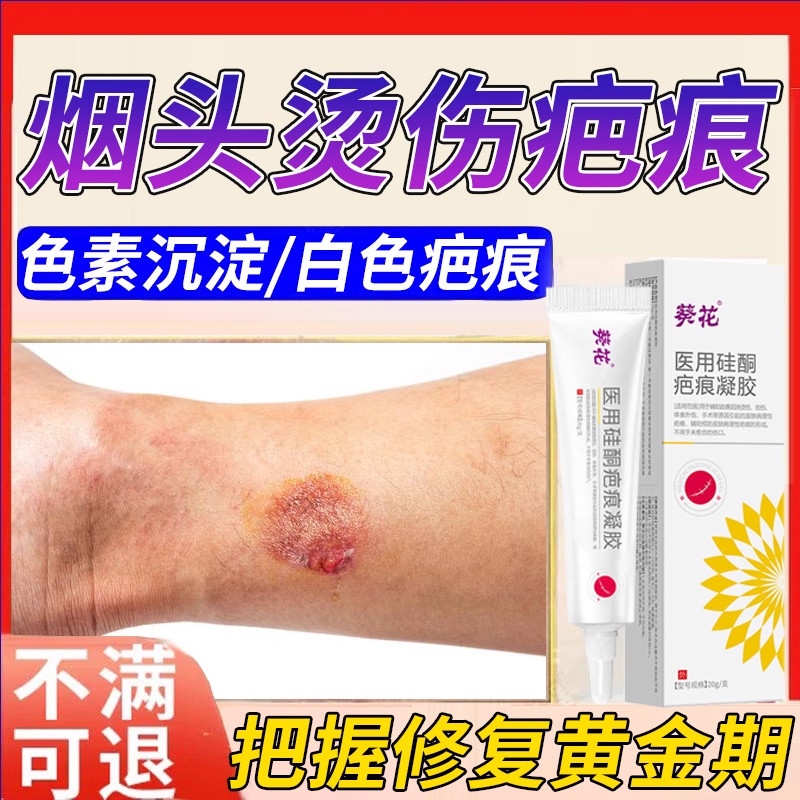 烟头烫伤去疤膏去烟疤痕增生疤印黑色素沉淀烧伤葵花修复除疤膏LB