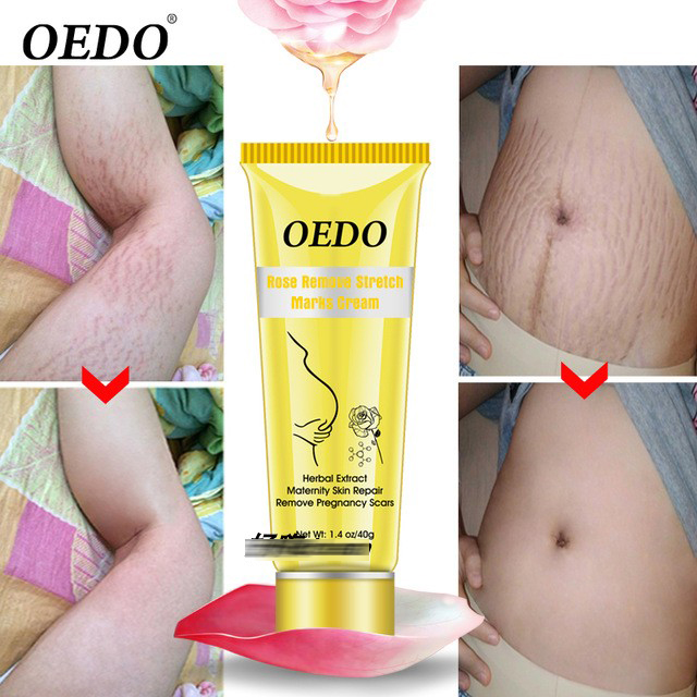 Rose Remove Stretch Marks Cream Maternity Body Skin Repair-封面