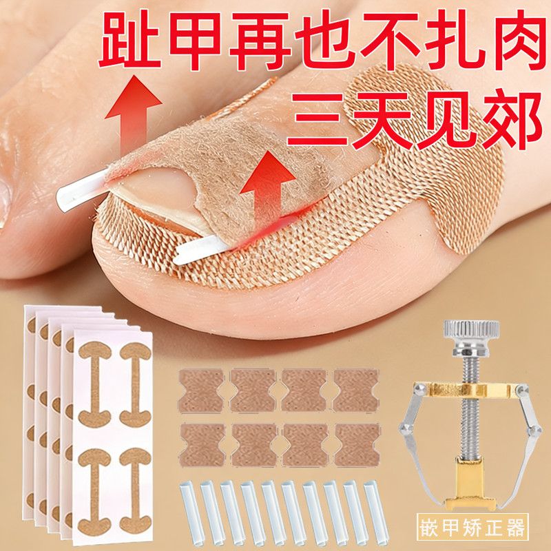 脚指甲盖矫正器甲沟贴嵌