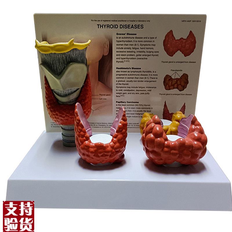 甲状腺解剖模型甲状腺结s节乳突癌桥本甲状腺炎甲状腺肿人体医学