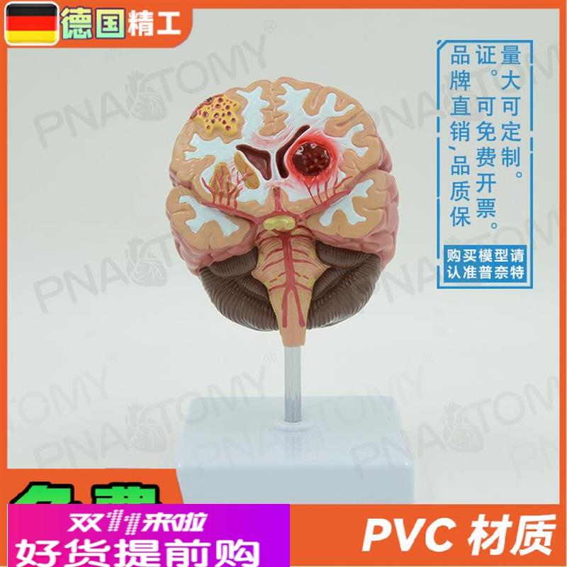 德国】人脑病理解剖模型脑geng大脑疾病血管堵塞标本 教学脑科神