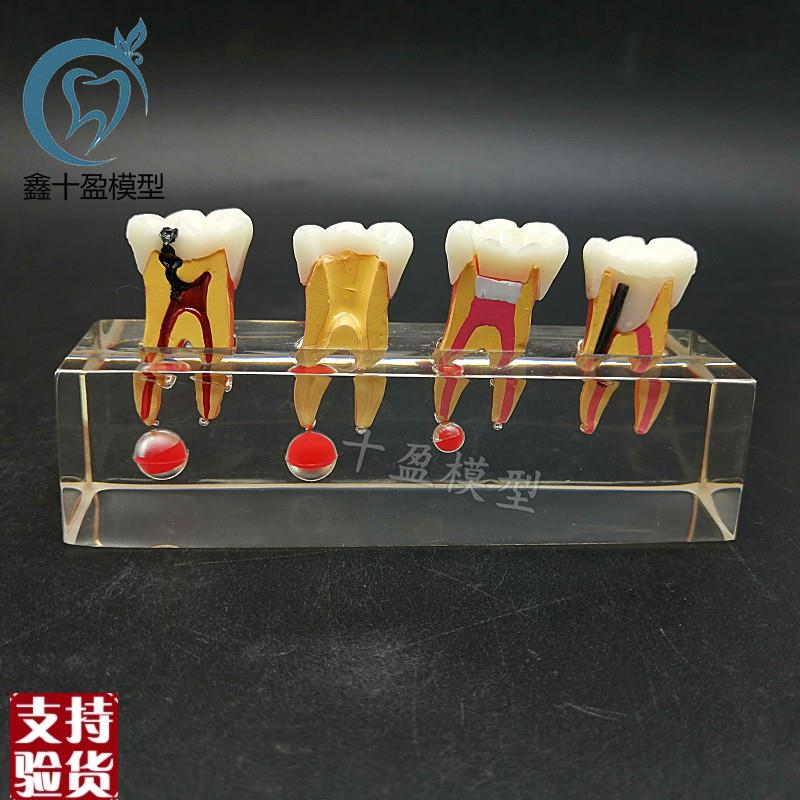 牙科教学模型乳牙龋病模型可拆分牙髓F修复医患沟通M4018包邮