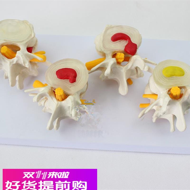 4阶段病态腰椎比较模型人体四个时期病变腰部脊柱脊椎模具标本