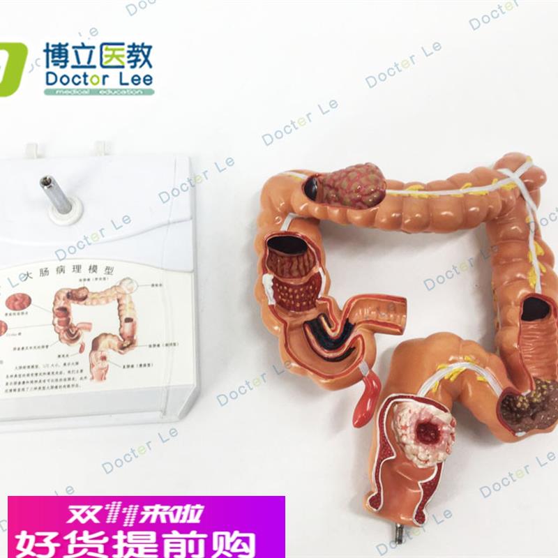 教学结肠病理模型大肠病变标本肠道医患沟通交流人体器官解剖