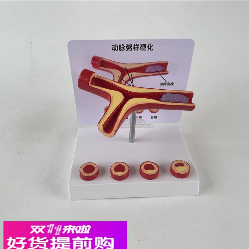 人体血管病理粥样动脉/硬化模型 病变血栓/血管/病演示心解剖教具
