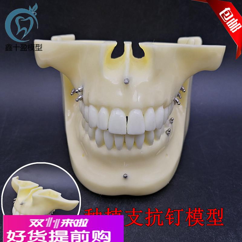 牙科 种植支抗钉模型  练习种植模型牙科教学模型口腔教学示分解
