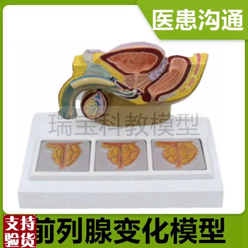 前列腺比较模型病理变化增大生肥尿道F狭窄男科医患中老年人前列