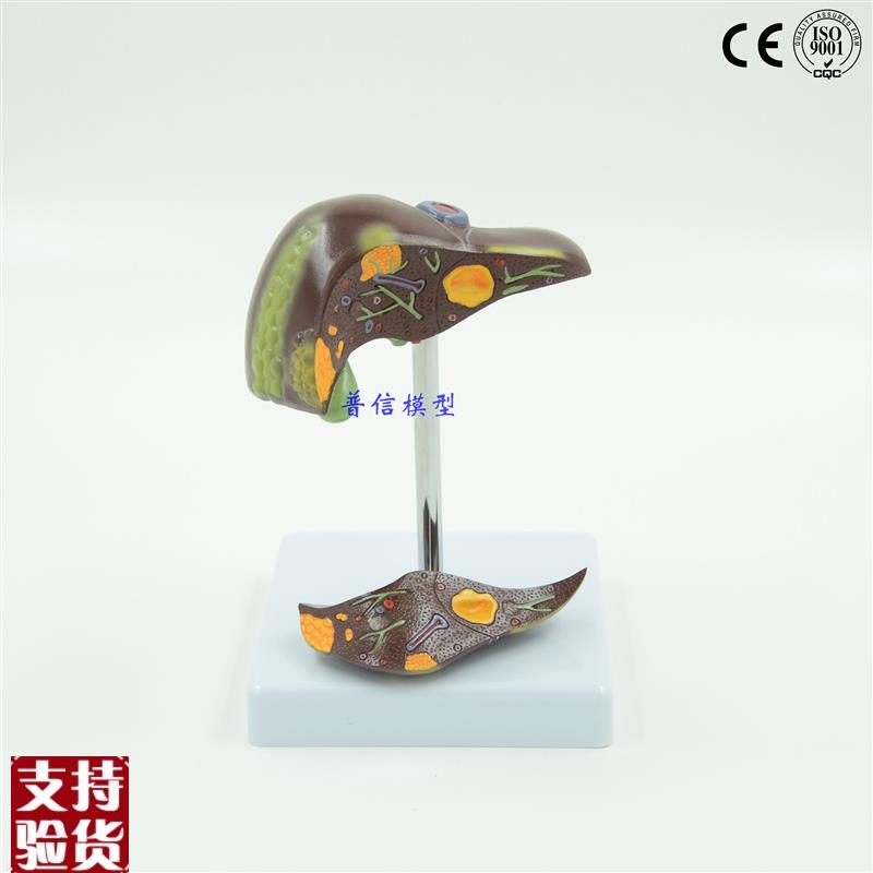 普信肝脏病理病理肝o模型结石模型医用消化内科模型礼品模型