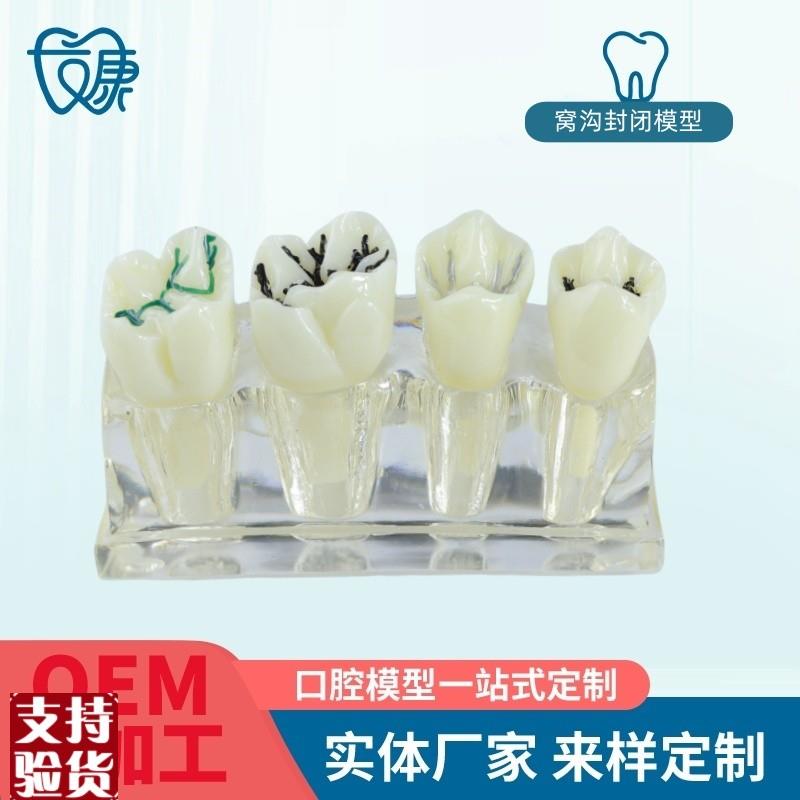 透明窝沟封闭模型牙科口腔教学牙模种植修复病理模型Y牙齿模型厂