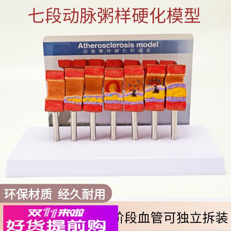 动脉粥样硬化模型血管血栓栓塞模型动脉血管人体医用医学教学模型