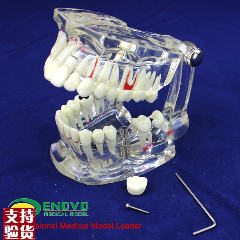 ENOVO颐诺牙齿模型q口腔牙齿科种植模型口腔病理模型种植体牙冠义