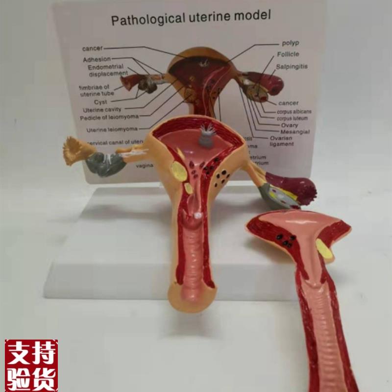 包邮女性病理子k宫模型妇产子宫结构解剖仿真病态子宫